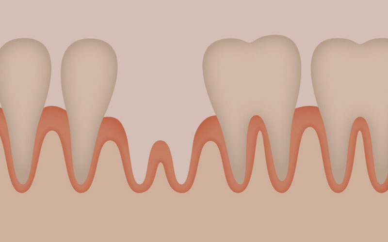 周囲の歯への影響